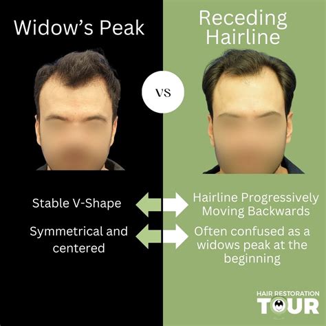 Widow's Peak | Stable V-Shape Versus Hair Loss