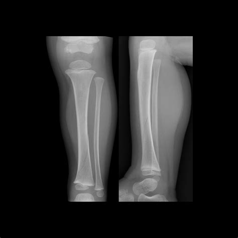 Toddler Fracture | Pediatric Radiology Reference Article | Pediatric