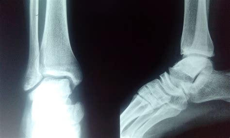 What may be the diagnosis in a 26M with bilateral feet pain? | ResearchGate