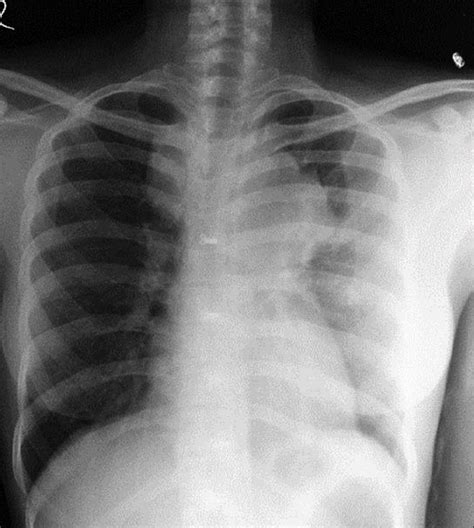 Generalized lymphadenopathy with TB lymphadenitis-CD4 count 110 ...