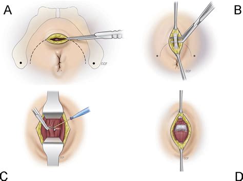 Robot Assisted Radical Prostatectomy Using Single Port Perineal