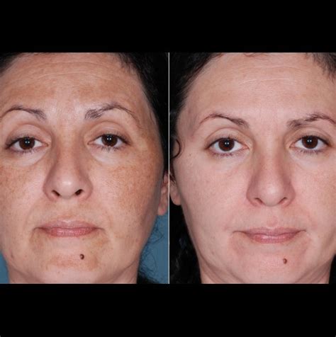 Домашен серум с витамин C-Рецепта за видима промяна и подмладяване на ...