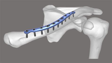 Clavicle Cambridge Shoulder