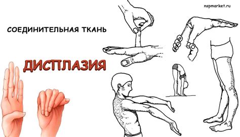 Дисплазия у детей и взрослых, признаки и степени дисплазии