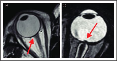axial  weighted mri shows normal appearance   optic nerve