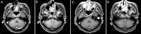 Postcontrast T1 Weighted Axial Magnetic Resonance Imaging Mri The