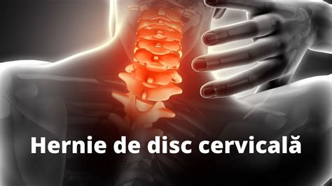 Ce este hernia de disc cervicală kinetoterapie durerecervicala YouTube