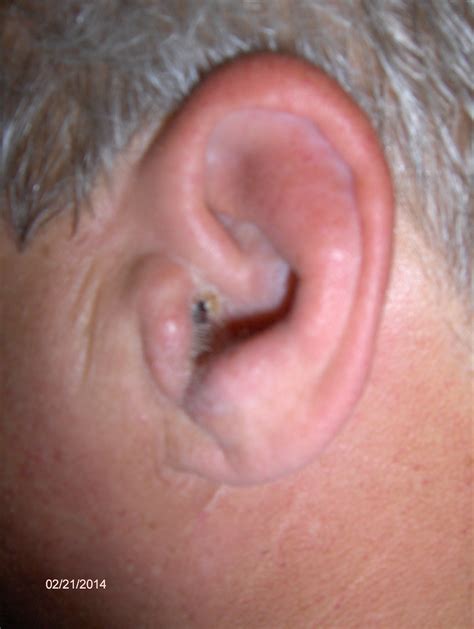 Swimmer’s Ear, External Otitis Urgent Care Orlando 34786 - Urgent Care