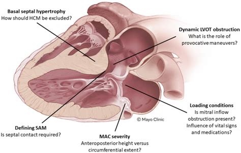 Defining The Role Of Mitral Annular Calcification In Mitral Valve