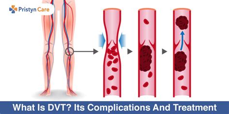 What Is DVT? Its Complications and Treatment - Pristyn Care