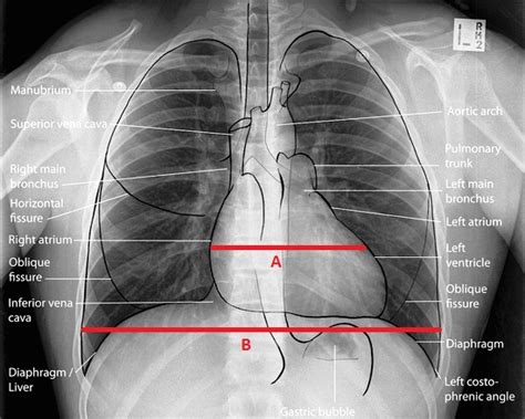 Cardiomegaly X Ray Tacitceiyrs