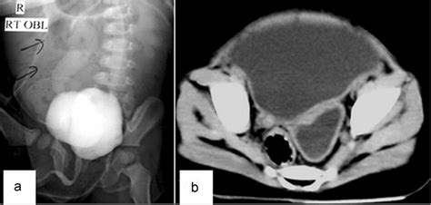 Bladder Diverticulum Cystoscopy