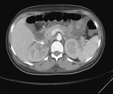 Abdominal Ct Scan Showing At Least One Right Renal Infarct Download Scientific Diagram