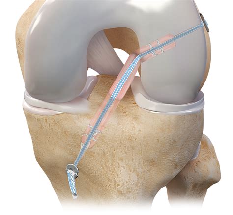 Arthrex Hamstring Autograft Acl Reconstruction