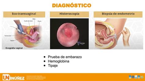 Hemorragia Uterina Anormal En Ginecologia Causas Diagnostico Y