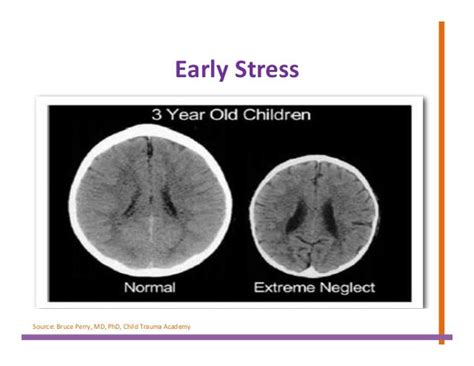 Childhood Traumas Impact On The Developing Brain
