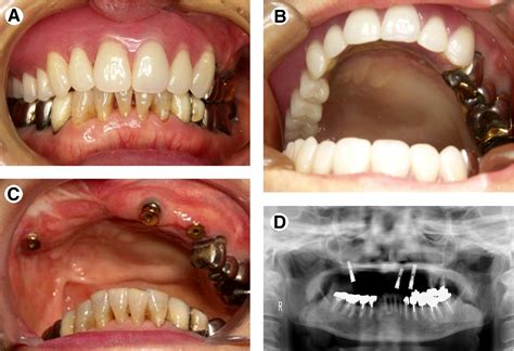 Oral Rehabilitation Of A Maxillectomy Defect Using Bone Transport