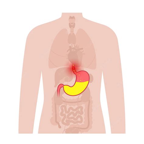 Premium Vector Gastroesophageal Reflux Disease Poster Digestive