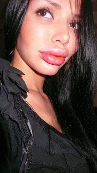 LOL ON A DAILY BASIS Hot Girl Gets Plastic Surgery And Now Looks Like A Duck QUACK QUACK