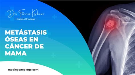 Câncer De Mama Metástase Óssea Sobrevida - Metástasis Óseas En Cáncer De Mama | Dr. Franco Krakaur | Cirujano ...