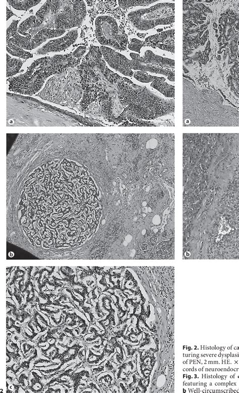 Figure 3 From Clinicopathological Features Of Patients With Concomitant