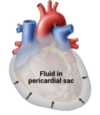 Emergency Medicine Cardiac Pulmonary Flashcards Quizlet