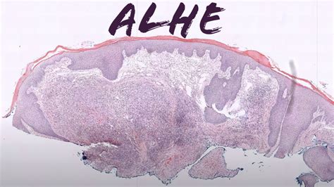 Epithelioid Hemangioma Angiolymphoid Hyperplasia With Eosinophilia