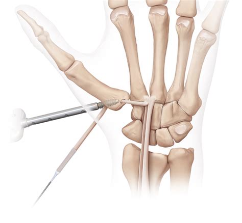 Arthrex Ligament Reconstruction Tendon Interposition