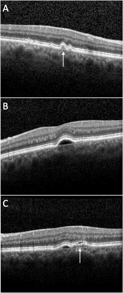 Pigment Epithelial Detachment Eyewiki