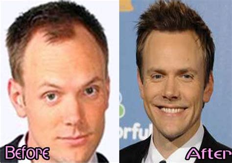 Joel McHale Hair Transplant Before And After Photo ~ Celebrity plastic