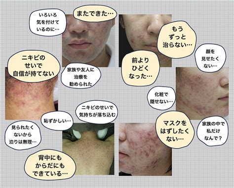 一般皮膚科でも治らない重症ニキビ治療に メディアージュ ニキビクリニック