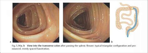 Descending Colon Sigmoid Colon Rr School Of Nursing