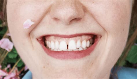 how to fix teeth gap at home