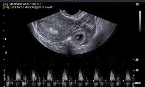 Ectopic pregnancy Ultrasound Tech, Sonographer, Antenatal, Ectopic ...