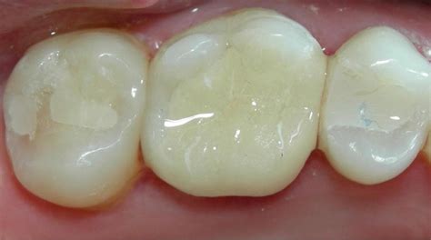 Are Composite Dental Fillings Safe? | Dental Solutions of Avon/Indy