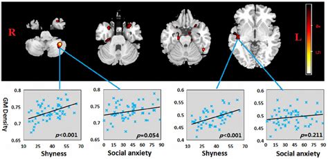 Regions Showing Positive Correlation Between GM Density And Shyness