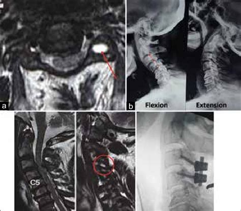 A T2 Weighted Axial Magnetic Resonance Imaging Image Of A Myelopathic