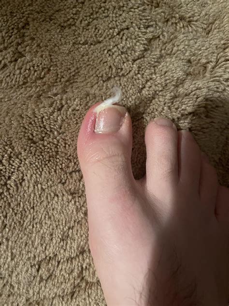 Partial Toenail Removal What Does A Partial Matricectomy Look Like?