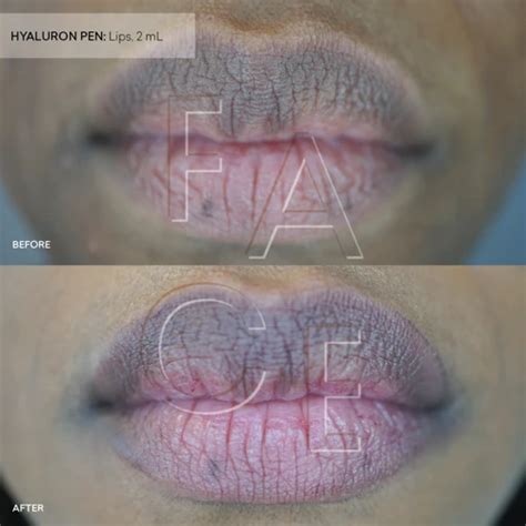 How To Massage Migrated Lip Filler A Step By Step Guide