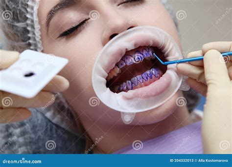 The Dentist Applies The Tooth Of A Purple Gel On The Patient S Teeth