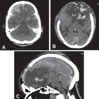 PDF Decompressive Craniectomy For Traumatic Brain Injury In Hospital