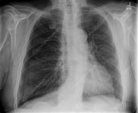tension pneumothorax  ray stock image  science photo library
