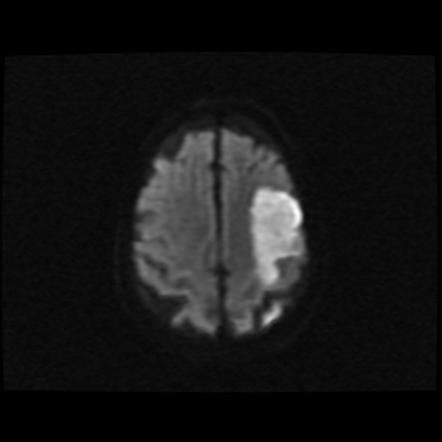 Diffusion-weighted imaging in acute ischaemic stroke | Radiology ...