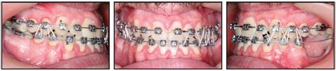 Carriere Nonsurgical Class Iii Open Bite Correction From Jco