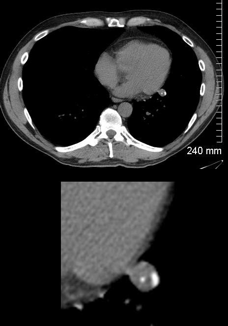 Nodules Calcification Eccentric Lungs