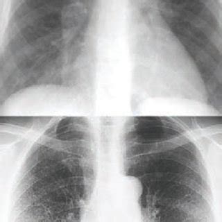 The Four Radiological Stages Of Pulmonary Sarcoidosis Stage 1