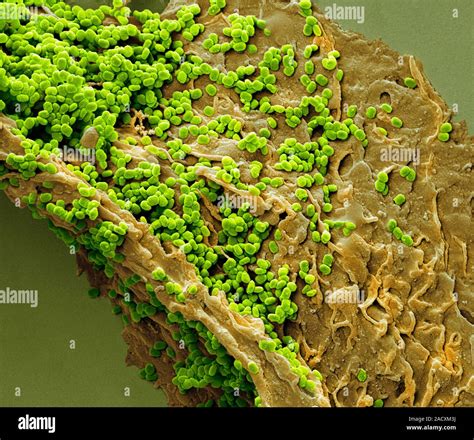 Molluscum Contagiosum Coloured Electron Micrograph Sem Molluscum