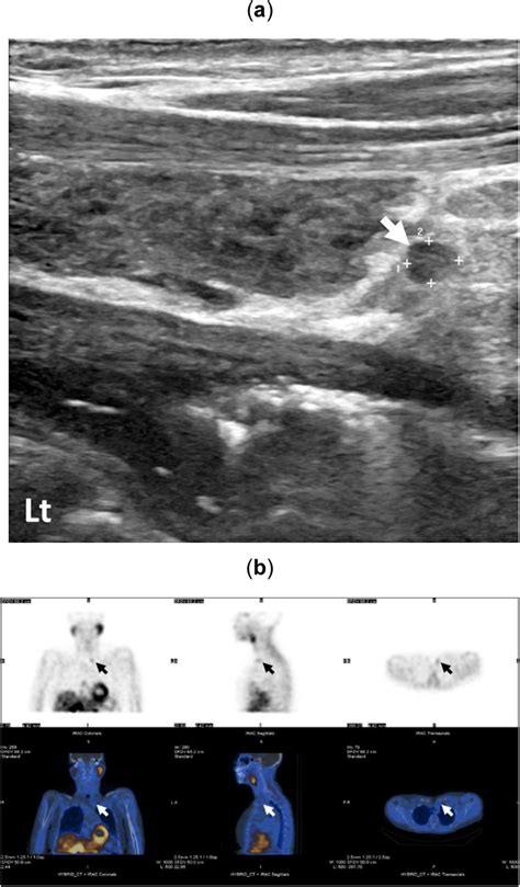 Parathyroid Adenoma Identified By Ultrasound Scan Measuring 2 6 × 2 1