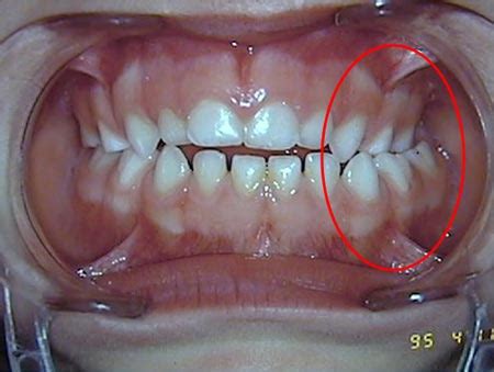 Mordida Cruzada Fotos Ilustrativas Odontologia Marques