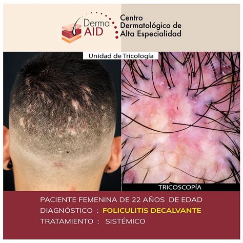🌱🔍 ¡descubre La Foliculitis Decalvante 💡💼 ¿sabías Que La Foliculitis